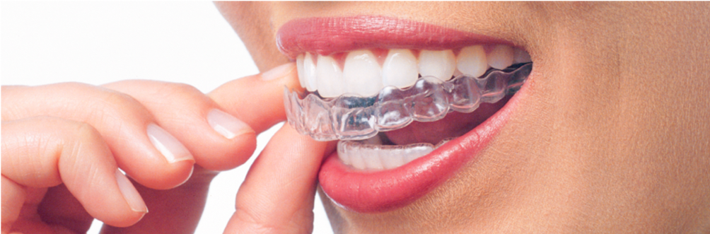 Orthondontie invisalign